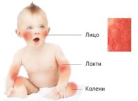 Схема основных мест проявления диатеза у детей