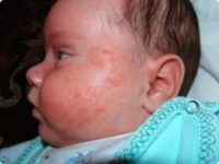 Фотография проявления симптомов диатеза у новорожденного