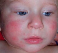 Фото диатеза у детей на лице