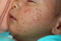 Фотография проявления симптомов диатеза у детей на лице