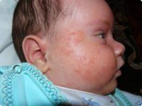 Фотография симптомов диатеза у новорожденных