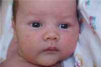 Фото диатеза у новорожденного на лице