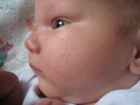 Фотография симптомов диатеза у новорожденного на лице
