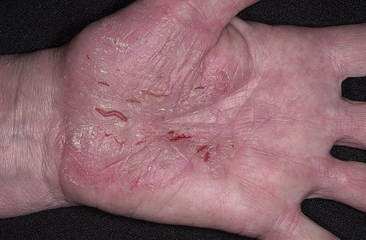 Псориаз заразен или нет для кожи окружающих (фото)