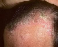 Фото симптомов проявления псориаза на голове