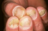Фото симптомов проявления псориаза ногтей