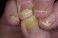 Фото псориаза ногтей на руках