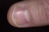 Фото симптомов проявления псориаза ногтей на руках