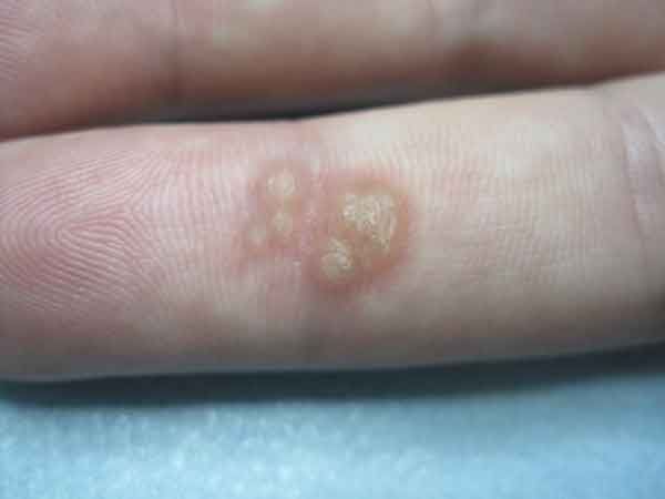Бородавка на пальце: фото как выглядит, почему появляется и лечение