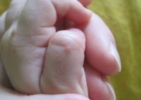 Фотография, как выглядит бородавка на руке у ребенка