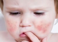 Фото диатеза на щеках у ребенка