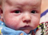 Фото, как выглядит диатез на щеках у ребенка