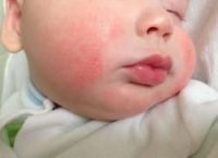 Фотография симптомов проявления диатеза на щеках у ребенка