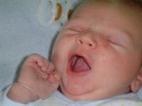 Фотография проявления симптомов диатеза у грудного ребенка на лице