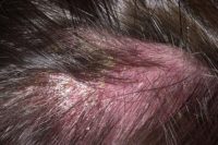 Фотография проявления симптомов себореи кожи головы