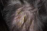 Фотография симптомов себореи на голове