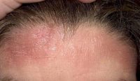 Фото, как выглядит себорейный дерматит на голове