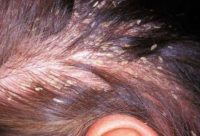 Фотография проявления симптомов себорейного дерматита на коже головы
