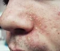 Фото себорейного дерматита на лице