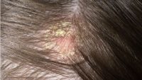 Фото себорейного дерматита волосистой части головы