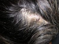 Фото, как выглядит себорейный дерматит волосистой части головы