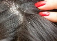 Фотография симптомов себорейного дерматита волосистой части головы