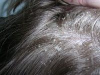 Фото жирной себореи кожи головы