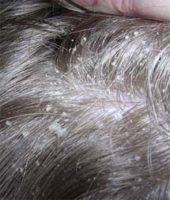 Фотография жирной себореи кожи головы