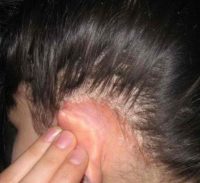 Фото, как выглядит себорейный дерматит на голове у взрослых и детей