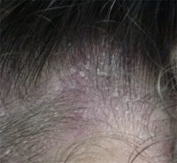 Фото, как выглядит сухая себорея головы