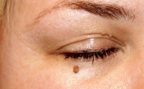 Папилломы вокруг глаз причины и лечение