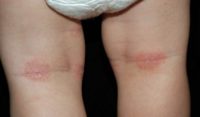 Фотография, как выглядит атопический дерматит у ребенка на ногах