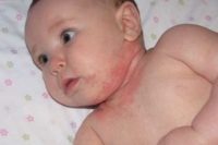 Фотография, как выглядит атопический дерматит у грудного ребенка