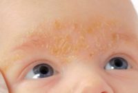 Фотография, как выглядит себорейный дерматит у ребенка