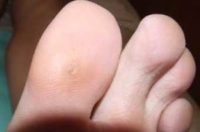Фотография, как выглядит шипица на пальце ноги