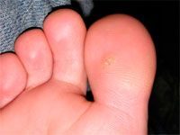 Фотография шипицы на пальце ноги