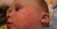 Фото аллергического дерматита у детей