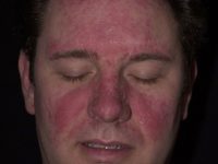 Фото атопического дерматита на лице