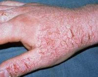 Фото атопического дерматита на руках