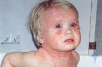 Фото атопического дерматита у детей