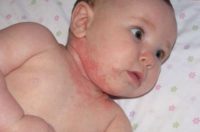 Фотография, как выглядит атопический дерматит у ребенка