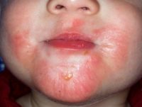 Фотография, как выглядит атопический дерматит у детей