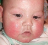 Фотография атопического дерматита у детей, который можно вылечить с помощью крема и мази