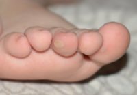 Фотография, как выглядит бородавка у ребенка на пальце
