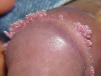 Фотография как выглядит проявление папилломавируса у мужчин на половых органах