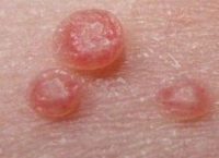 Фото проявления папилломавирусной инфекции у женщин
