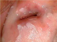 Фотография, как выглядят проявления папилломавирусной инфекции у женщин