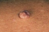 Фотография проявления папиломавирусной инфекции у мужчин в виде единичной папилломы на коже