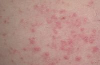 Фото себорейного дерматита на теле
