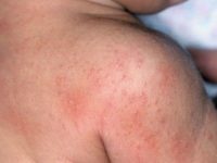 Фотография, как выглядит себорейный дерматит на теле человека